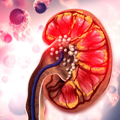 ayurvedic kidney treatment